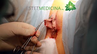 Уменьшение малых половых губ | Labiaplasty 18+