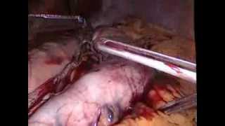 İLEAL İNTERPOZİSYON (Şeker Hastalığı Ameliyatı) VİDEOSU OP. DR. TUĞRUL DEMİREL