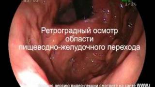 Скользящая грыжа пищеводного отверстия диафрагмы