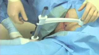 T-SPeC Cystostomy: Live Female with BMI of 50 and Neurogenic Bladder