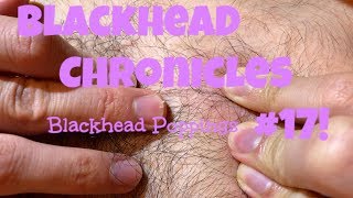 Blackhead Chronicles - Popping Blackheads #17