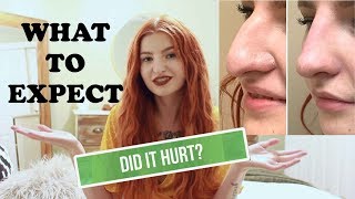 I GOT A NON-SURGICAL NOSE JOB