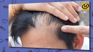 Как лечить облысение? | Алопеция | Формула Здоровья