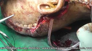 Scalp Cancer surgery by Dr Majid Ahmed Talikoti & Team