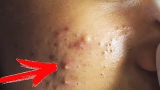 УДАЛЕНИЕ БОЛЬШИХ ЧЕРНЫХ ТОЧЕК И ПРЫЩЕЙ (МЕРЗКО)