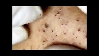 Выдавливание чёрных точек НОВОЕ! Удаление чёрных точек за ухом. p13