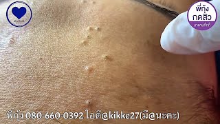 Выдавливание чёрных точек НОВОЕ! Полная чистка лица от чёрных точек. Прыщи - выдавливание и удаление