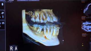 Evaluation of Referral Patient with Recession using the CS 9300