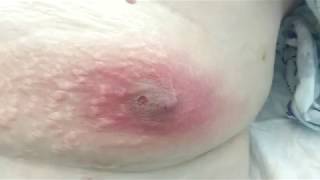 A  Big Subcutaneous Abscess  Большой подкожный абсцесс.