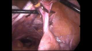 Total laparoscopic hysterectomy (Full procedure  )