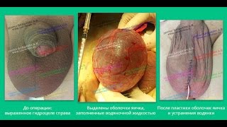 Водянка яичка - операция при гидроцеле