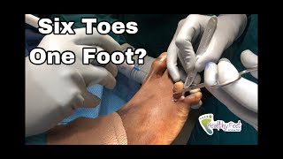 Six Toes On One Foot....One Must Go!