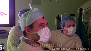 Смотри глазами хирурга!;) Get a surgeon’s vision!;) Верхняя лобэктомия. Upper lobectomy.