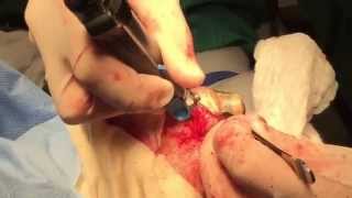 Amputation of toe with Gangrene, Toe Amputation