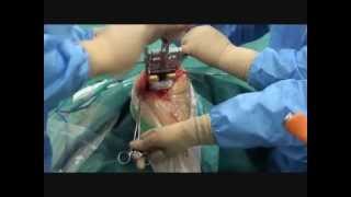PROTHESE TOTALE DE GENOU. Docteur Le Guilloux