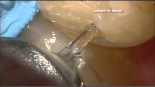 As Seen on IBN: Swapping the Drill for Dental Lasers