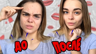 КАК ИЗБАВИТЬСЯ ОТ ПРЫЩЕЙ РАЗ И НАВСЕГДА
