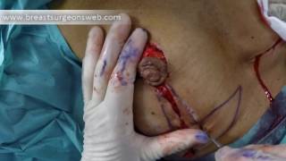 Oncoplastic Reduction Mammoplasty. Step by Step