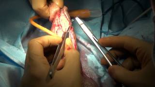 Orandi's Urethroplasty