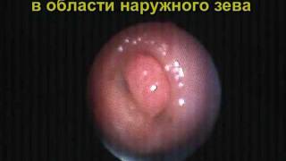Полип шейки матки с перекрученной ножкой