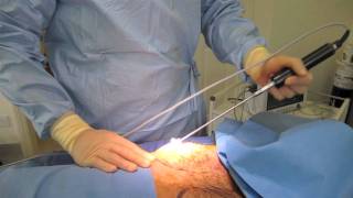 Live Highlights of Gynecomastia Surgery UK with VASER Lipo