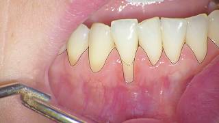 Connective tissue graft - Tunneling method