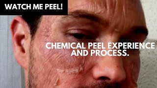WATCH ME PEEL! MY CHEMICAL PEEL EXPERIENCE AND PROCESS OF TCA ACID CHEMICAL PEEL