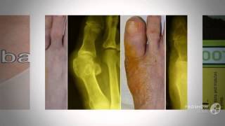 valgus plus купить в екатеринбурге

  -  Дефект ”шишек” на ноге??