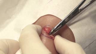 Watch & Learn: Lipoma excision
