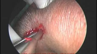 IATROGENIC FRONTAL SINUSITIS-NO LANDMARKS CASE-FRONTAL TREPHINE