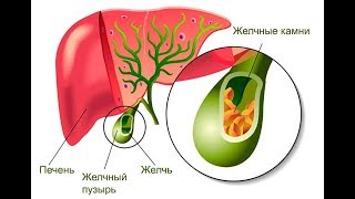 ОТЗЫВЫ /  Рассасались 30-летние КАМНИ в ЖЕЛЧНОМ пузыре по МЕТОДИКЕ Фролова Ю.А. / МЕДОВАЯ вода