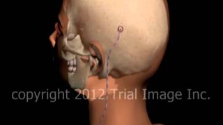Hydrocephalus shunt video by Dr. Cal Shipley, M.D.