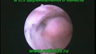 Удаление полипа игольчатым электродом.