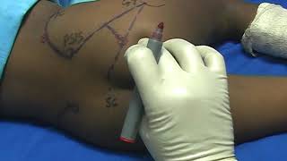 Pediatric PSOAS COMPARTMENT & SCIATIC N  BLOCK
