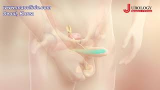 Penile Implant Pump Inflation & Deflation Demonstration - 음경임플란트 팽창과 이완 펌프 교육과 훈련 영상