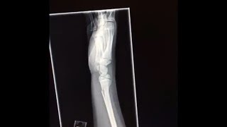 ?OH NO!!!!  IS IT BROKEN?!  Bad Hockey Injury!