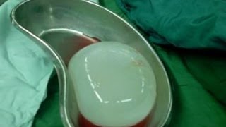 Операция. Удаление эхинококкового пузыря головного мозга. 18+