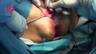 Устранение постгистерэктомического пролапса культи влагалища (Vaginal cuff prolapse repair)