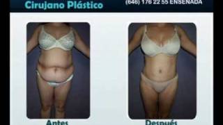 Dr. Manuel Nuñez Virgen -  Abdominoplastia -  Lipectomía