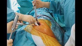 Prothèse totale de hanche mini-invasive : un nouvel abord