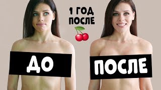 МАММОПЛАСТИКА, прошел ГОД!. До После. Увеличение ГРУДИ.