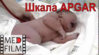 Шкала Апгар (APGAR) для новорожденных © Scale APGAR