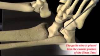 HyProCure - Podiatrist in Beverly Hills * Call Dr. Michael Bilinsky (310) 692-7250