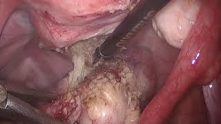 Myomectomy | Suspicious Fibroid | Vaginal extraction | Safe Laparoscopy