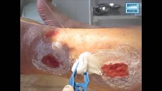 Лечение ран личинками. Язвы голени / Maggot debridment therapy. Lag ulcers