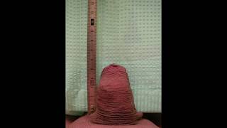 partial penectomy: long-term result in a patient case