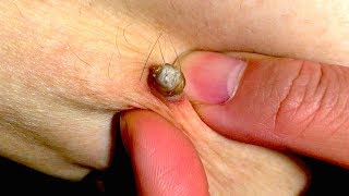 Выдавливание чёрных точек НОВОЕ! Удаление чёрных точек за ухом. p10