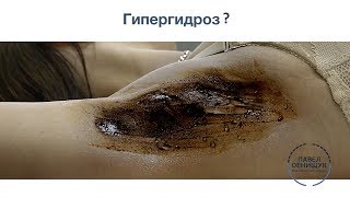 Сильно потеют подмышки? Тест на ГИПЕРГИДРОЗ