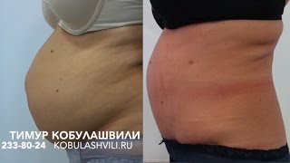 Грыжа белой линии живота: до и после