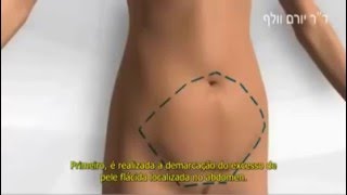 Abdominoplastia Explicada - Plástica do Abdome RJ